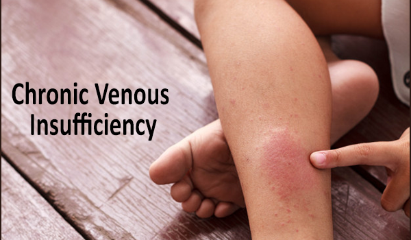 The stages of chronic venous insufficiency