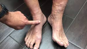 Lymphedema And Chronic Venous Insufficiency